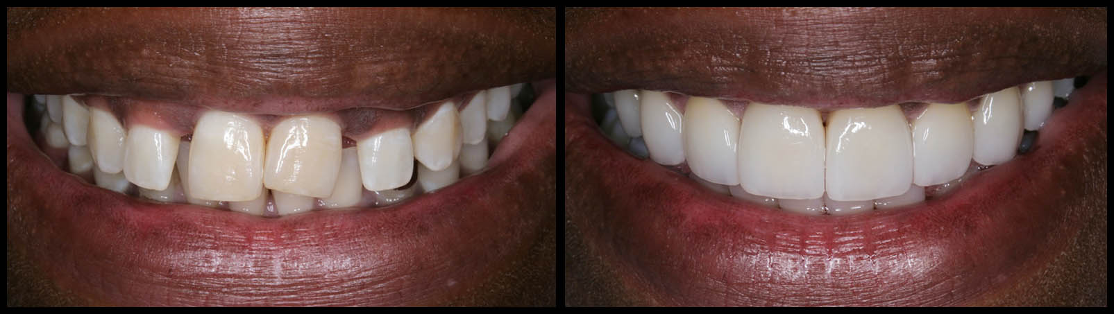 Gum Lift And Veneers Before And After | Bunker Hill Dentistry 