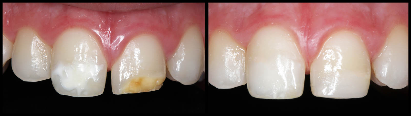 Dental filling before and after at Bunker Hill Dentistry