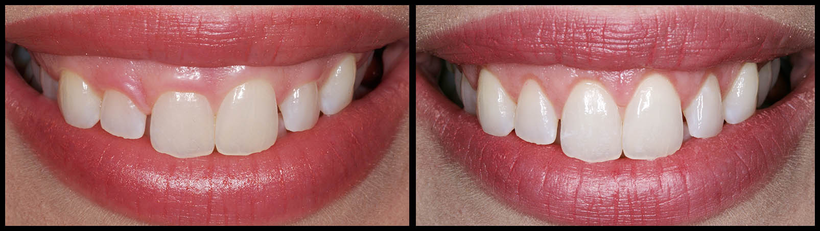 Gum Lift Surgery - Before and after photo at Bunker Hill Dentistry