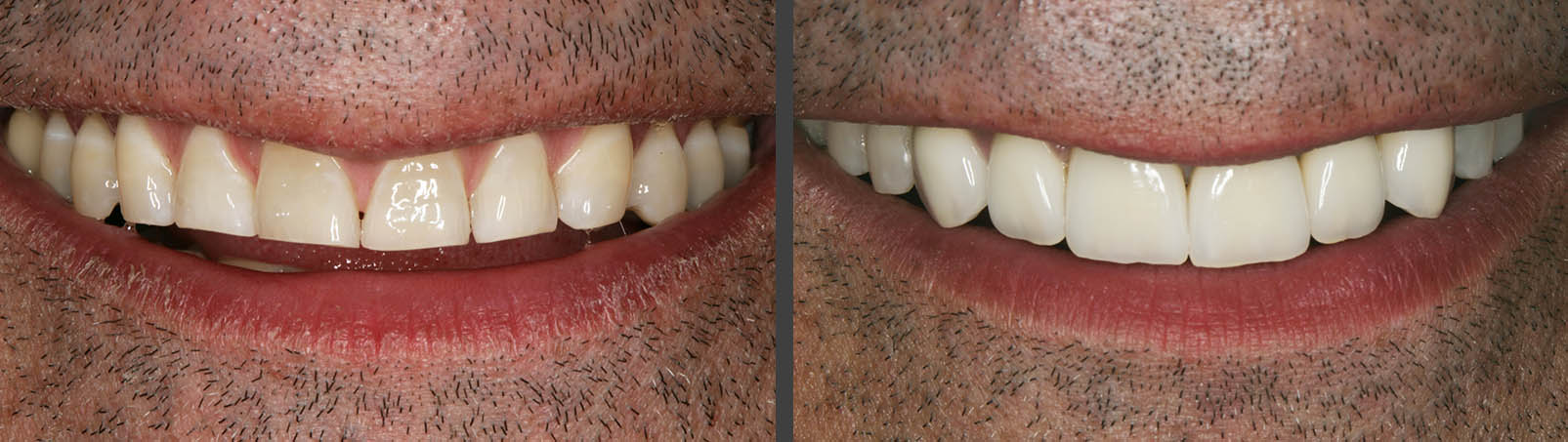 Veneers | Cosmetic Dentistry Before And After | Bunker Hill Dentistry | Houston,, TX