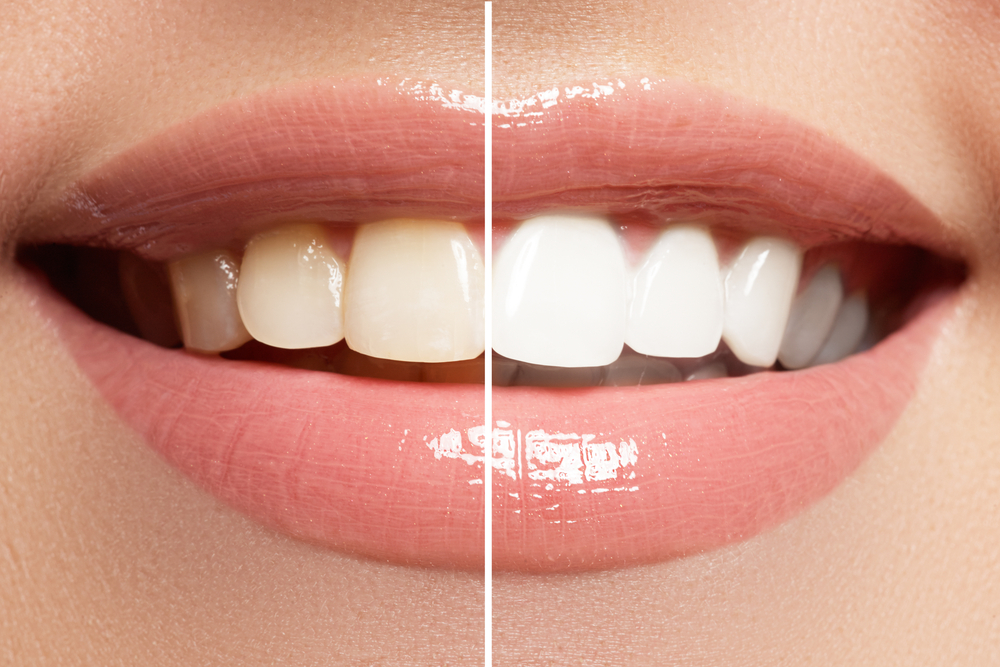 What to Avoid After Teeth Whitening: 7 Key Tips