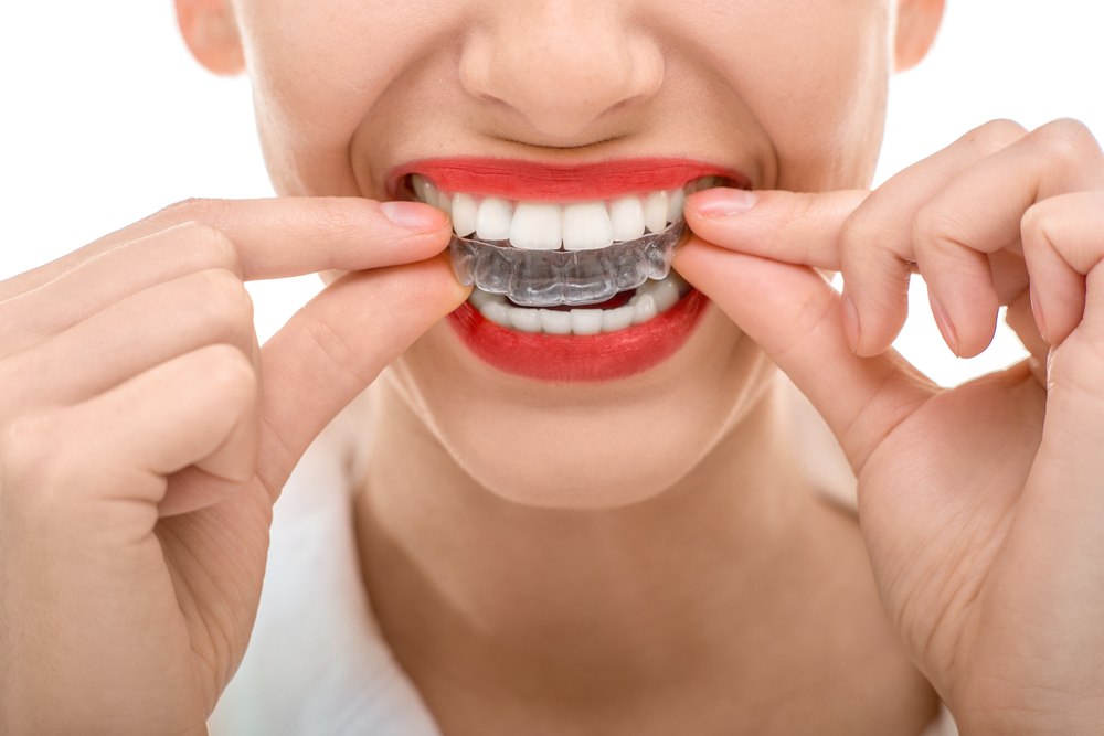 Invisalign Clear Braces New Westminster