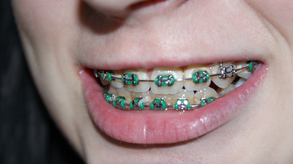 Young adult wearing traditional metal braces