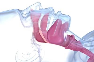 3D image of sleep apnea blocking airways