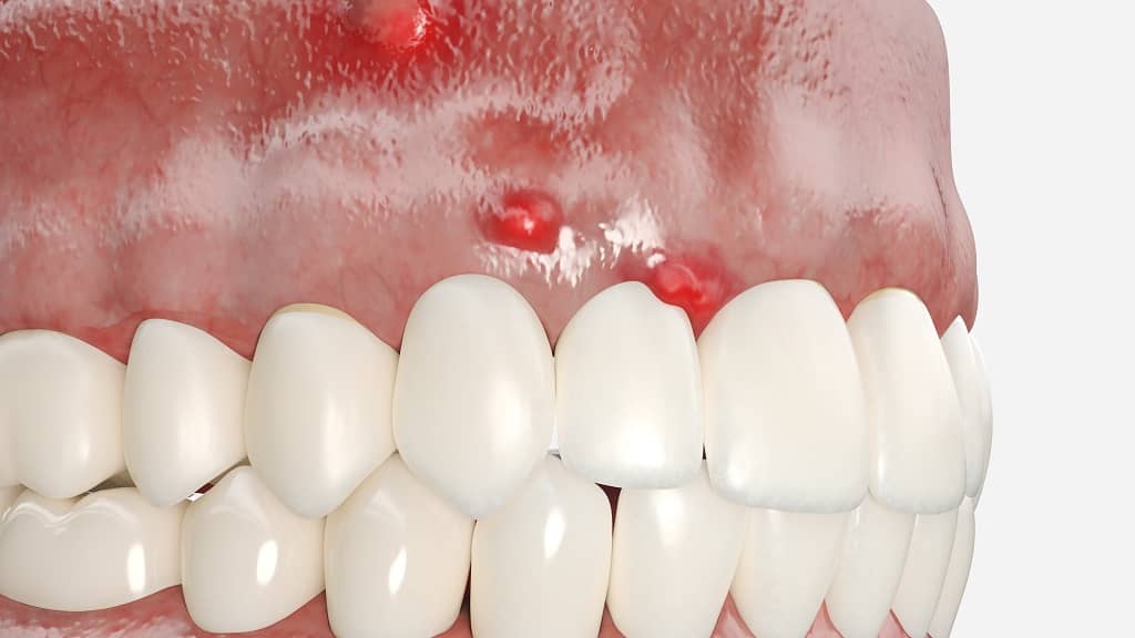 3 tooth abscesses on top gum 3D
