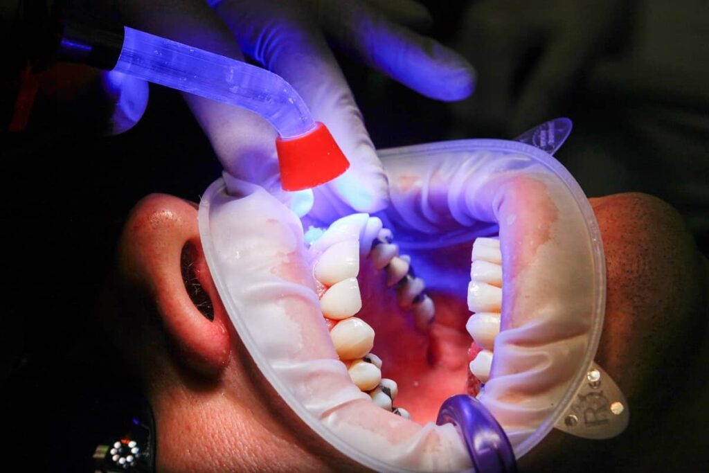 Curing dental bonding with UV light