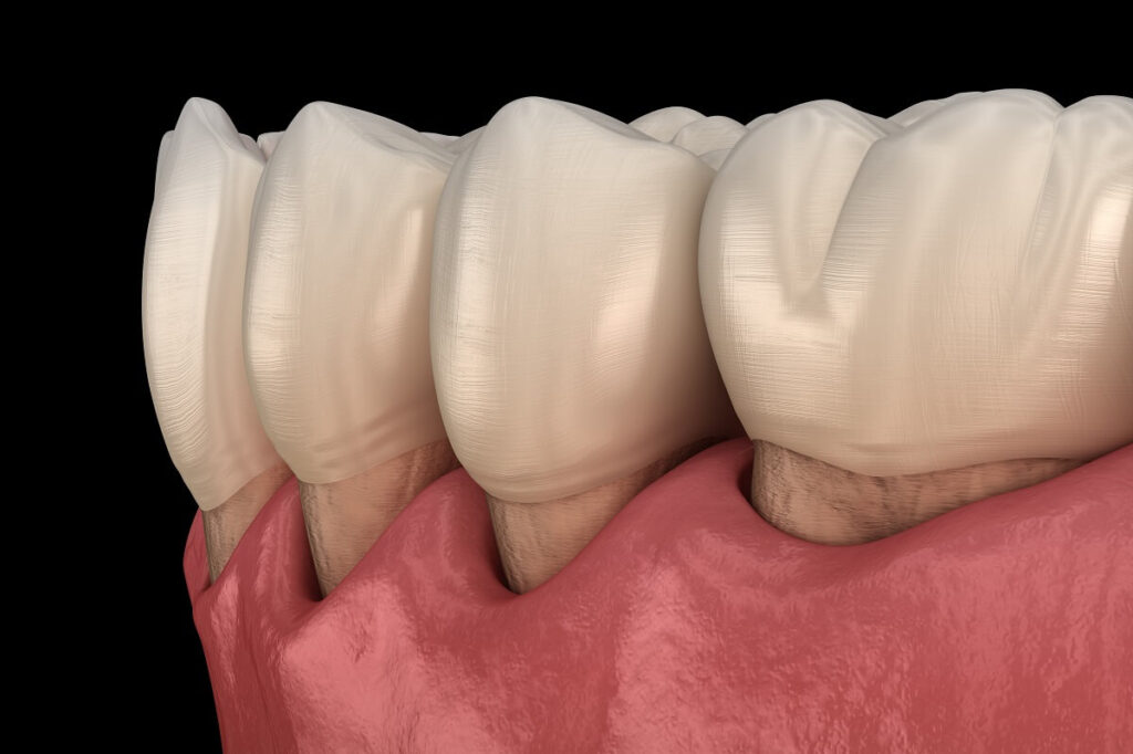 Receding gums on lower teeth
