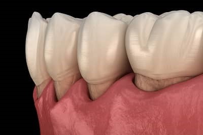 3D image of receding lower gums