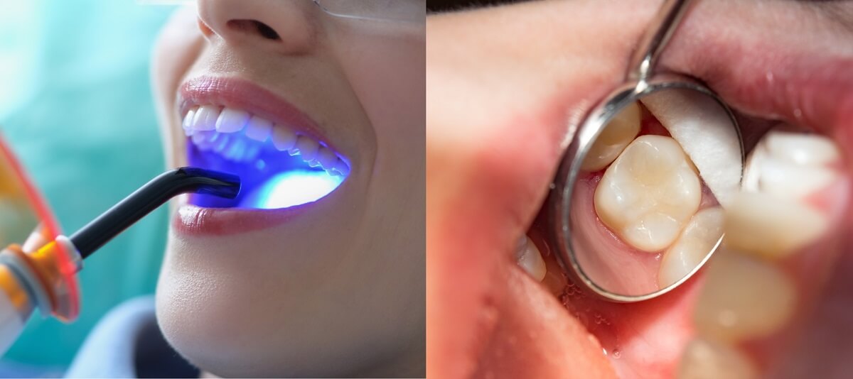 Is Dental Bonding the Same as a Filling? Uses, Procedures & Materials